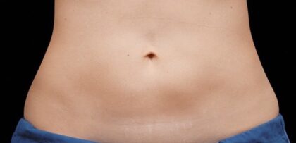 CoolSculpting Before & After Patient #12461