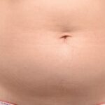 CoolSculpting Before & After Patient #12470