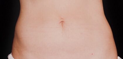 CoolSculpting Before & After Patient #12470