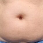 CoolSculpting Before & After Patient #12477