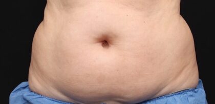 CoolSculpting Before & After Patient #12477
