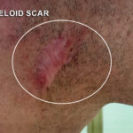 Keloid Before & After Patient #12768