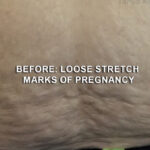 Stretch Marks Before & After Patient #12783