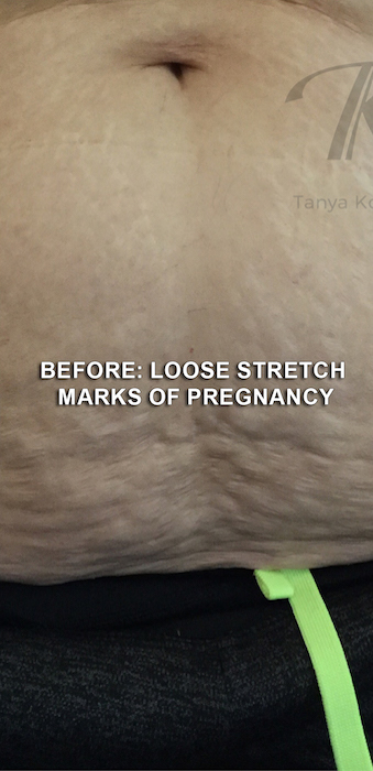 Patient #12783 Stretch Marks Before and After Photos Santa Monica - Plastic  Surgery Gallery Los Angeles - Dr. Tanya Kormeili