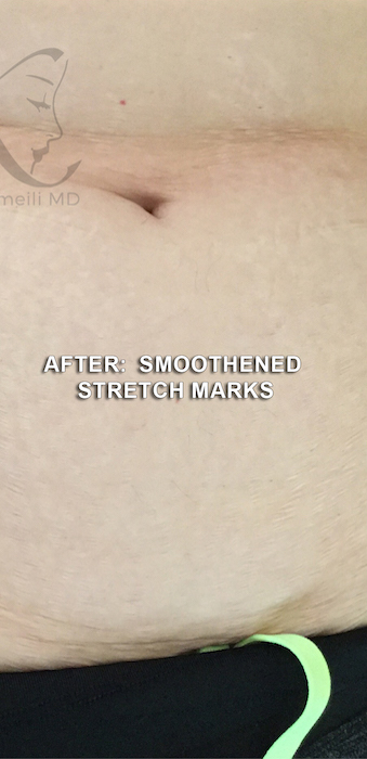 Stretch Marks Before & After Patient #12783