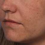 Fraxel Laser Therapy Before & After Patient #12317