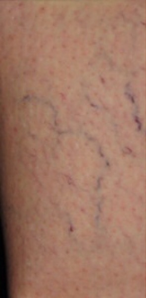 Sclerotherapy Before & After Patient #12449
