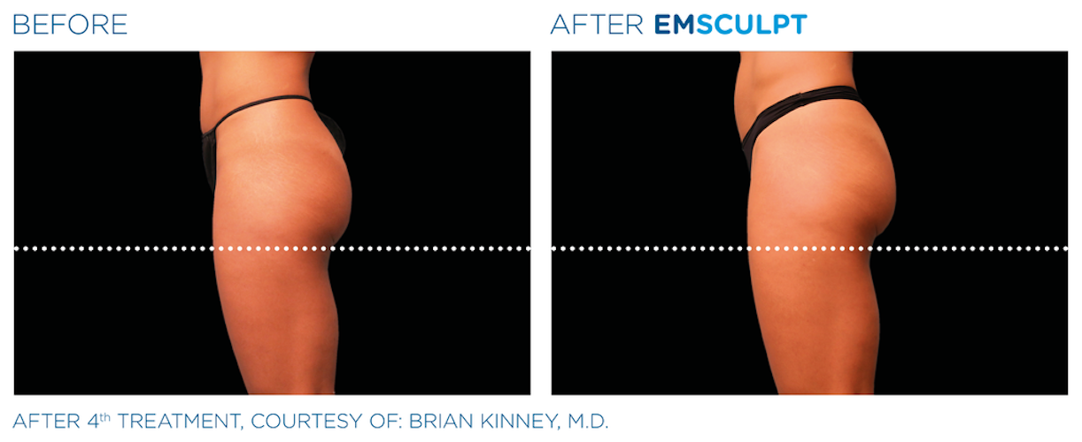 EMS Body Sculpting: Non-Invasive Body Contouring – SepiSpa