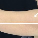 CoolSculpting Before & After Patient #13536