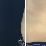 CoolSculpting Before & After Patient #13533