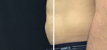 CoolSculpting Before & After Patient #13533