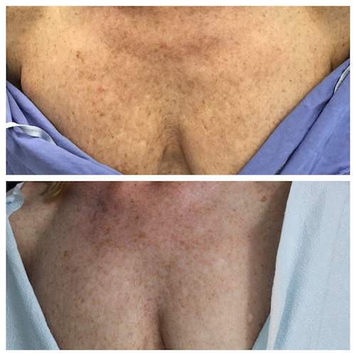 Prevention and Treatment Options for Vertical Chest Wrinkles - Summit  Plastic Surgery & Dermatology