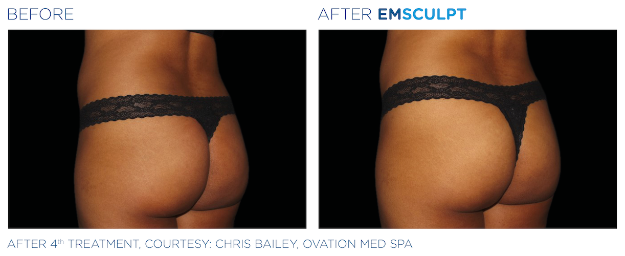 EMS Body Sculpting: Non-Invasive Body Contouring – SepiSpa