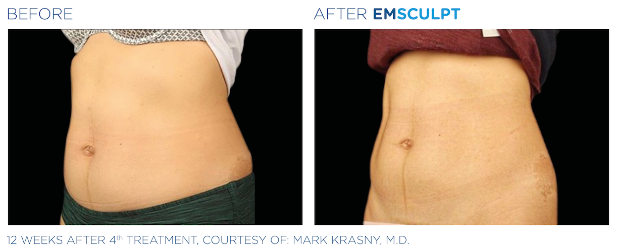 EmSculpt Treatment Los Angeles at Kormeili Dermatology