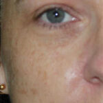 Acne Treatment Before & After Patient #13018