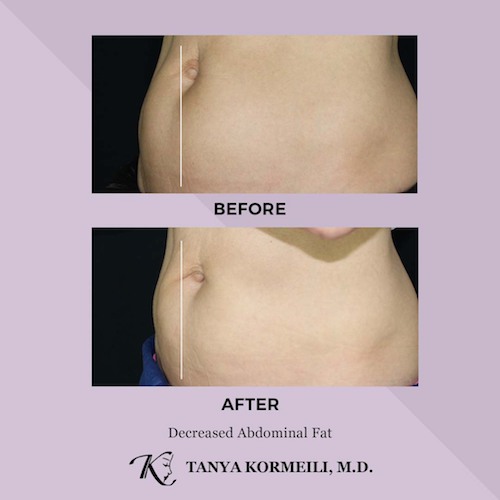 Long-term Effects of Coolsculpting, Beverly Hills, Los Angeles