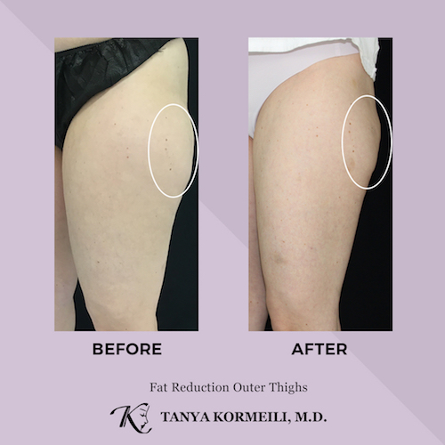 Best CoolSculpting Los Angeles Santa Monica Dr. Tanya Kormeili