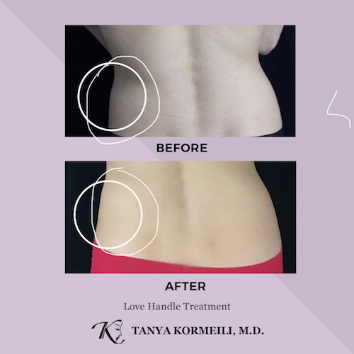 Love Handles CoolSculpting: Procedure, Results, Side Effects