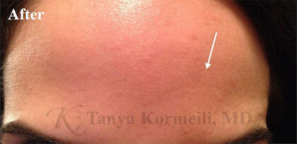 Forehead Lines Before & After Patient #13043