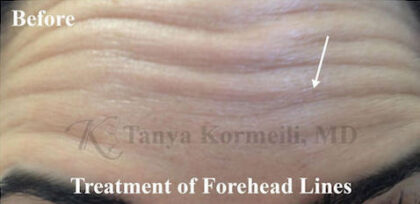 Forehead Lines Before & After Patient #13043