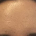 Forehead Lines Before & After Patient #13052