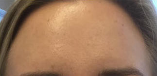 Forehead Lines Before & After Patient #13052