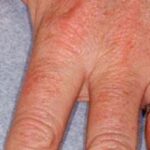 Hand Rejuvenation Before & After Patient #13272