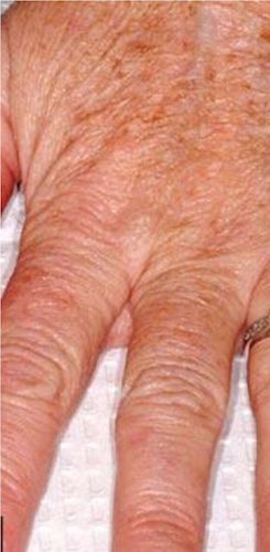 Hand Rejuvenation Before & After Patient #13272