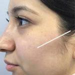 Jawline Contouring Before & After Patient #13034