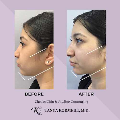 Jawline Contouring  Virginia, Washington D.C. and Maryland