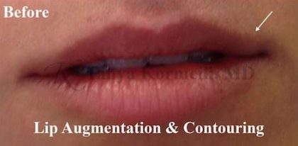 Lip Augmentation Before & After Patient #13492
