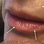 Lip Augmentation Before & After Patient #13495
