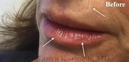 Lip Augmentation Before & After Patient #13495