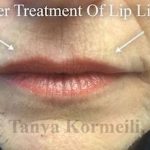 Lip Augmentation Before & After Patient #13498