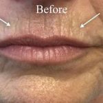 Lip Augmentation Before & After Patient #13498