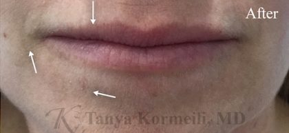 Lip Augmentation Before & After Patient #13501