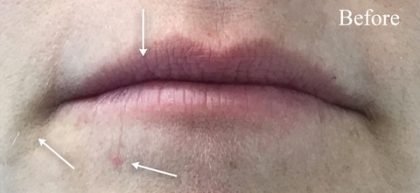 Lip Augmentation Before & After Patient #13501