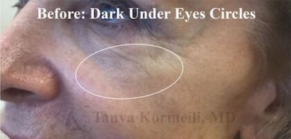 Dark Under Eyes Before & After Patient #13286