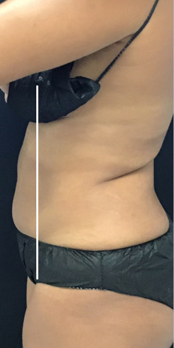 CoolSculpting Before & After Patient #13528