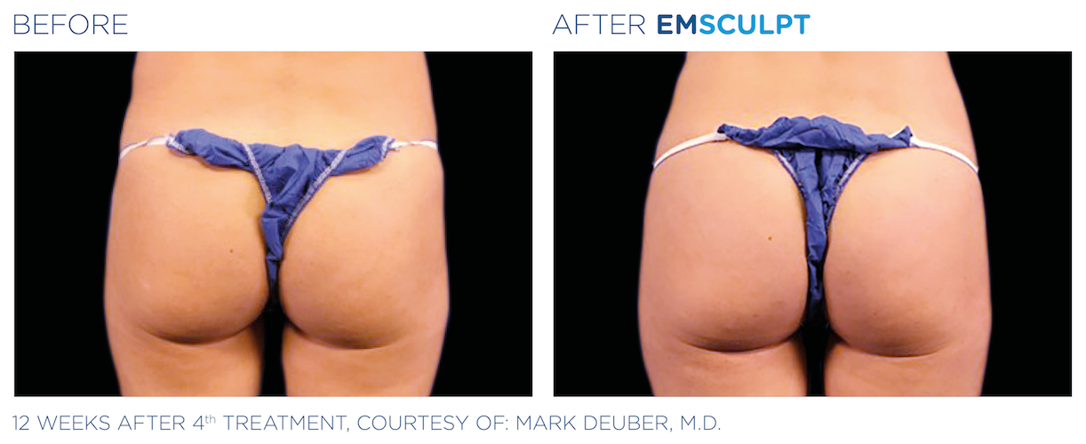 EMS Body Sculpting: Non-Invasive Body Contouring – SepiSpa