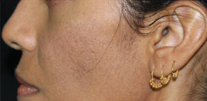 Scar Removal Before & After Patient #13003