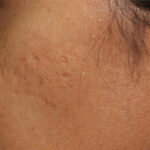 Acne Treatment Before & After Patient #13003