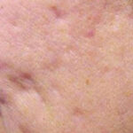 Acne Treatment Before & After Patient #12997