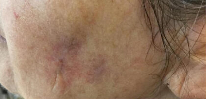 Scar Removal Before & After Patient #13006