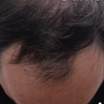 Hair Restoration Before & After Patient #13797