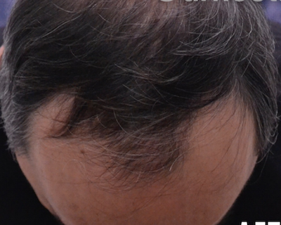 Hair Restoration Before & After Patient #13797