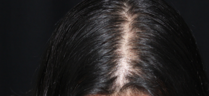 Hair Loss Treatment Before & After Patient #14218