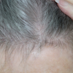 Hair Transplant Before & After Patient #14215