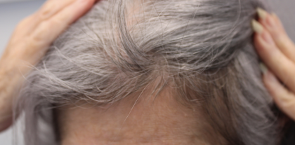 Hair Loss Treatment Before & After Patient #14215