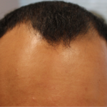 Hair Transplant Before & After Patient #14191
